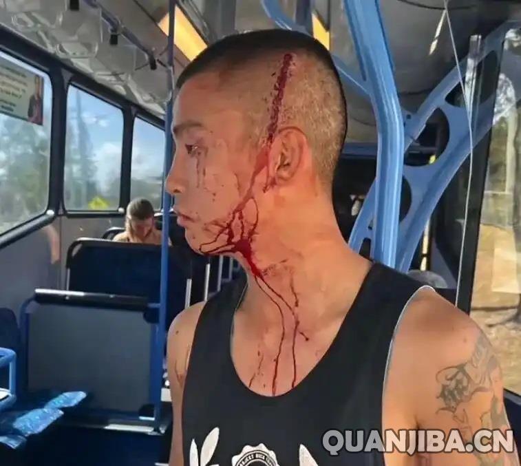 华人00后拳王与妻子在澳大利亚遭围殴，被锥子扎头险丧命